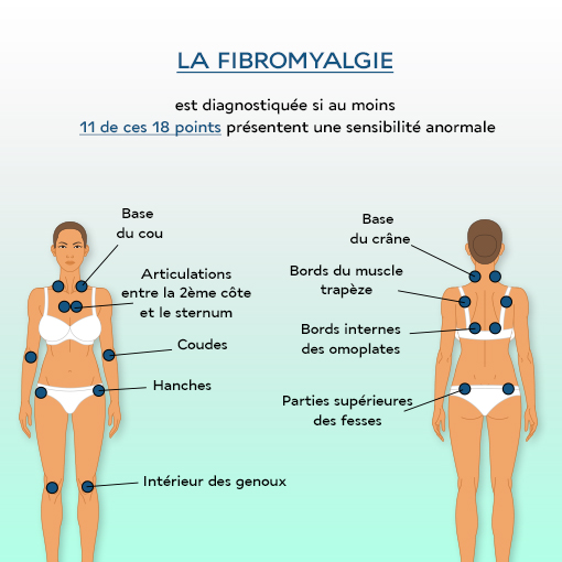 Detection 18 points fibromyalgie