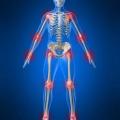 Arthrose